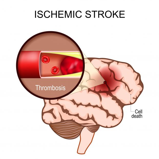 bigstock Ischemic Stroke Human Brain  461375049