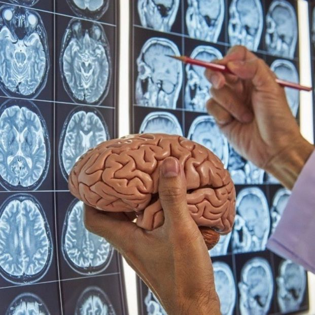 Inteligencia artificial para diagnosticar la enfermedad de Alzheimer