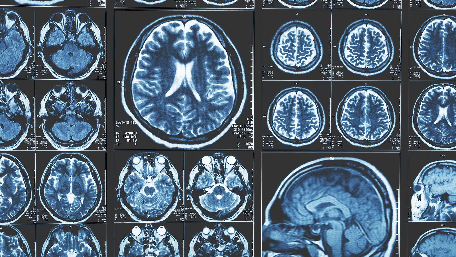 Descubren qué provoca la muerte neuronal que causa los síntomas del párkinson