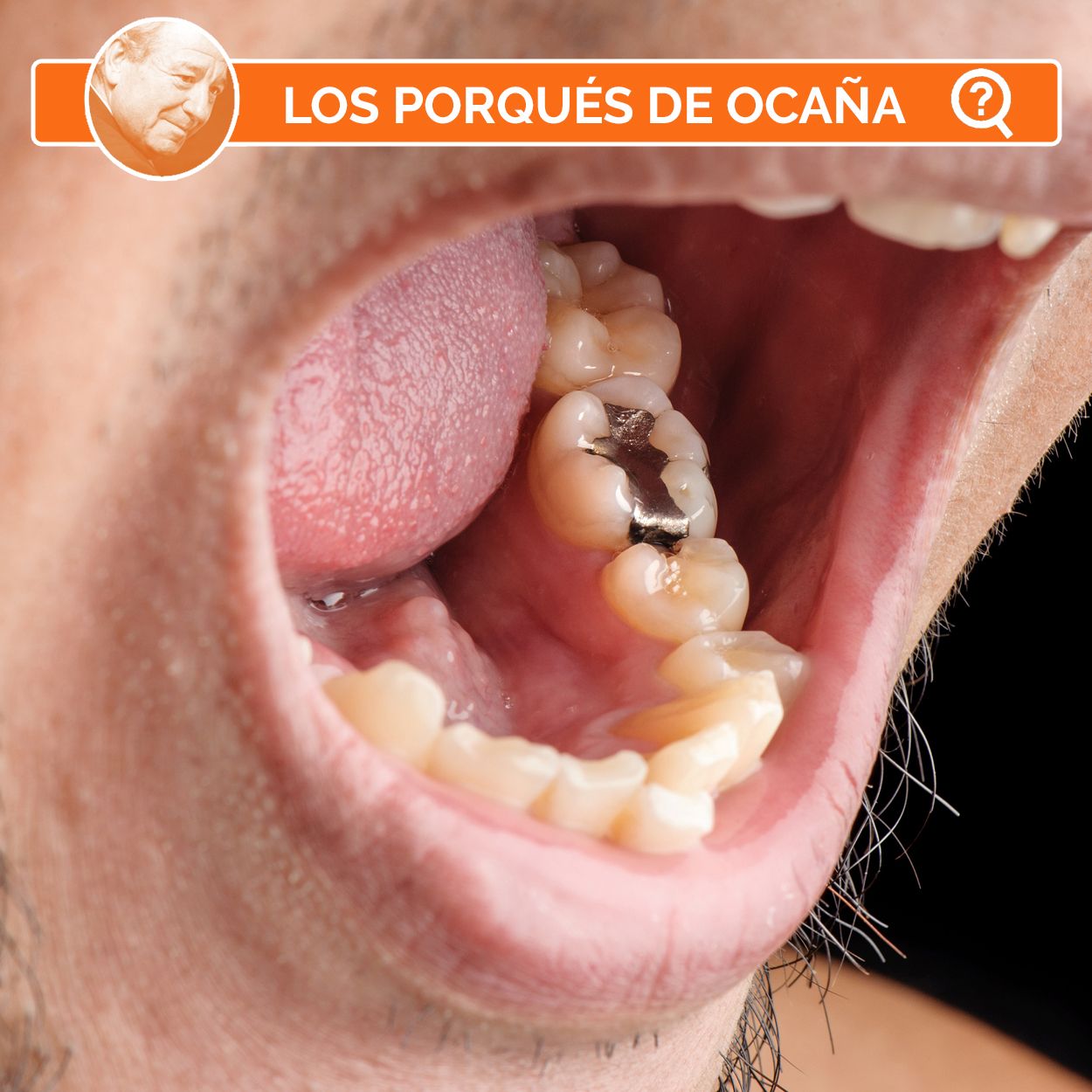 ¿Por qué ya no se usa la amalgama de plata para los empastes dentales?