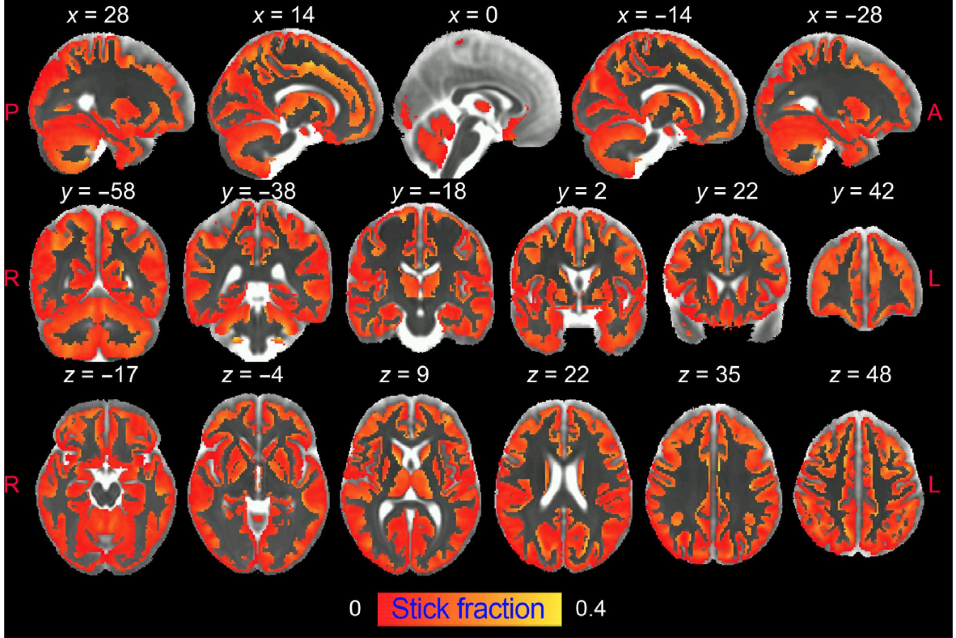 Una resonancia magnética permite ver la inflamación del cerebro 'in vivo' por primera vez