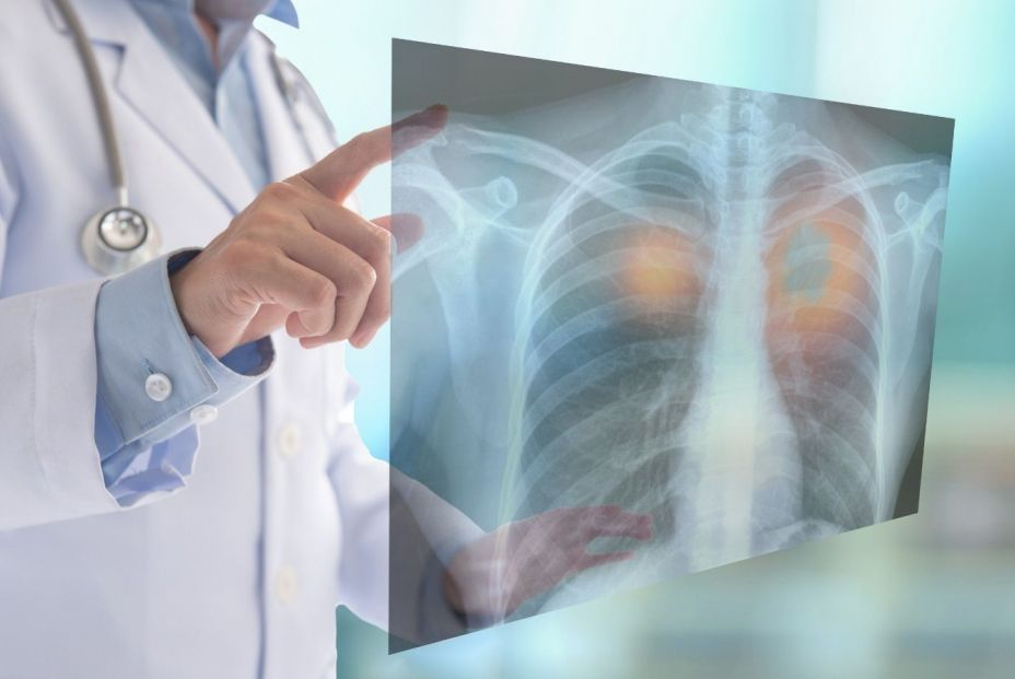 Descubren una nueva técnica que aumenta en un 80% la supervivencia en el cáncer de pulmón