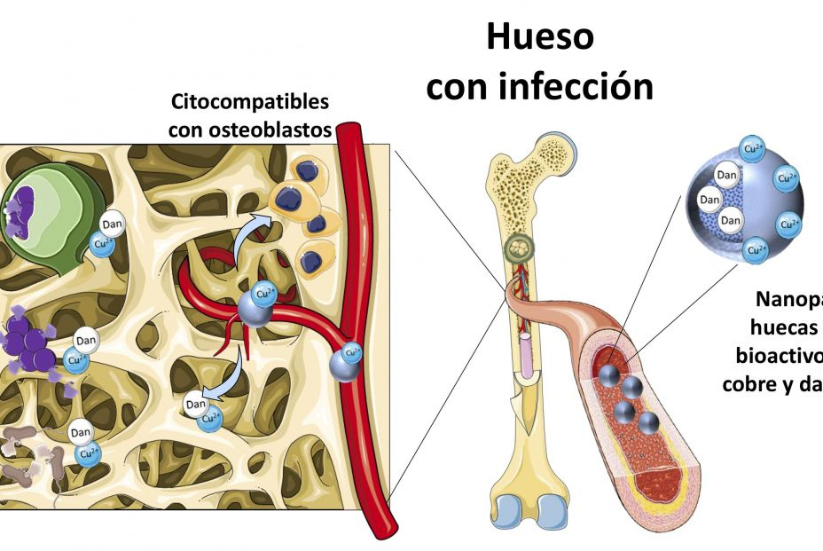 El nuevo avance en el tratamiento de infecciones óseas