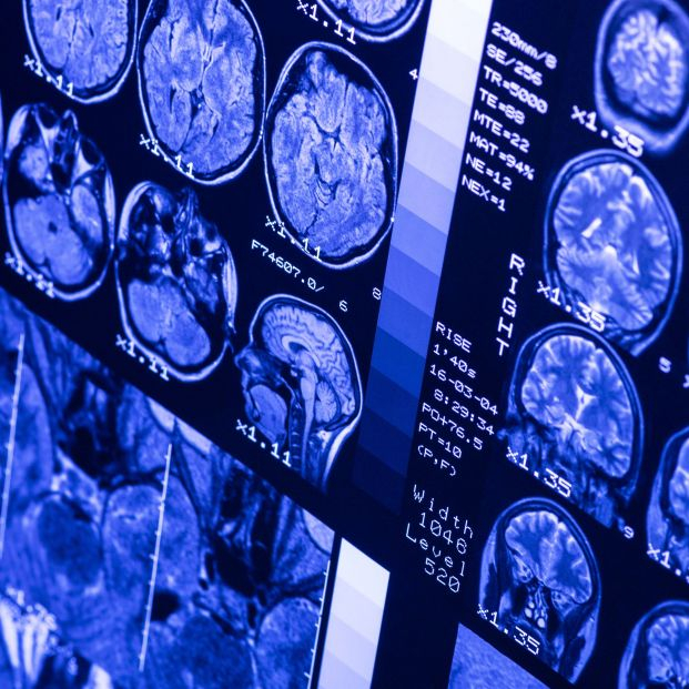 Una nueva técnica para el diagnóstico precoz del alzhéimer logra una fiabilidad del 98%