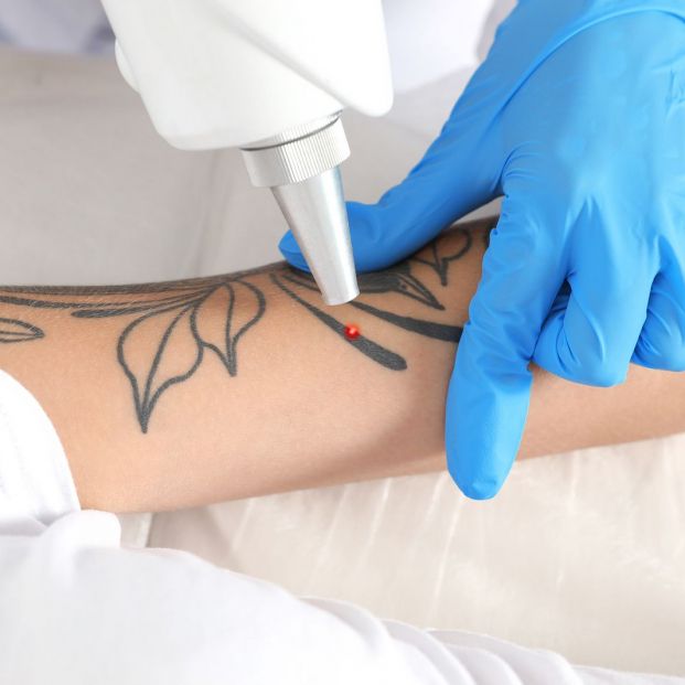Dudas a la hora de eliminar un tatuaje