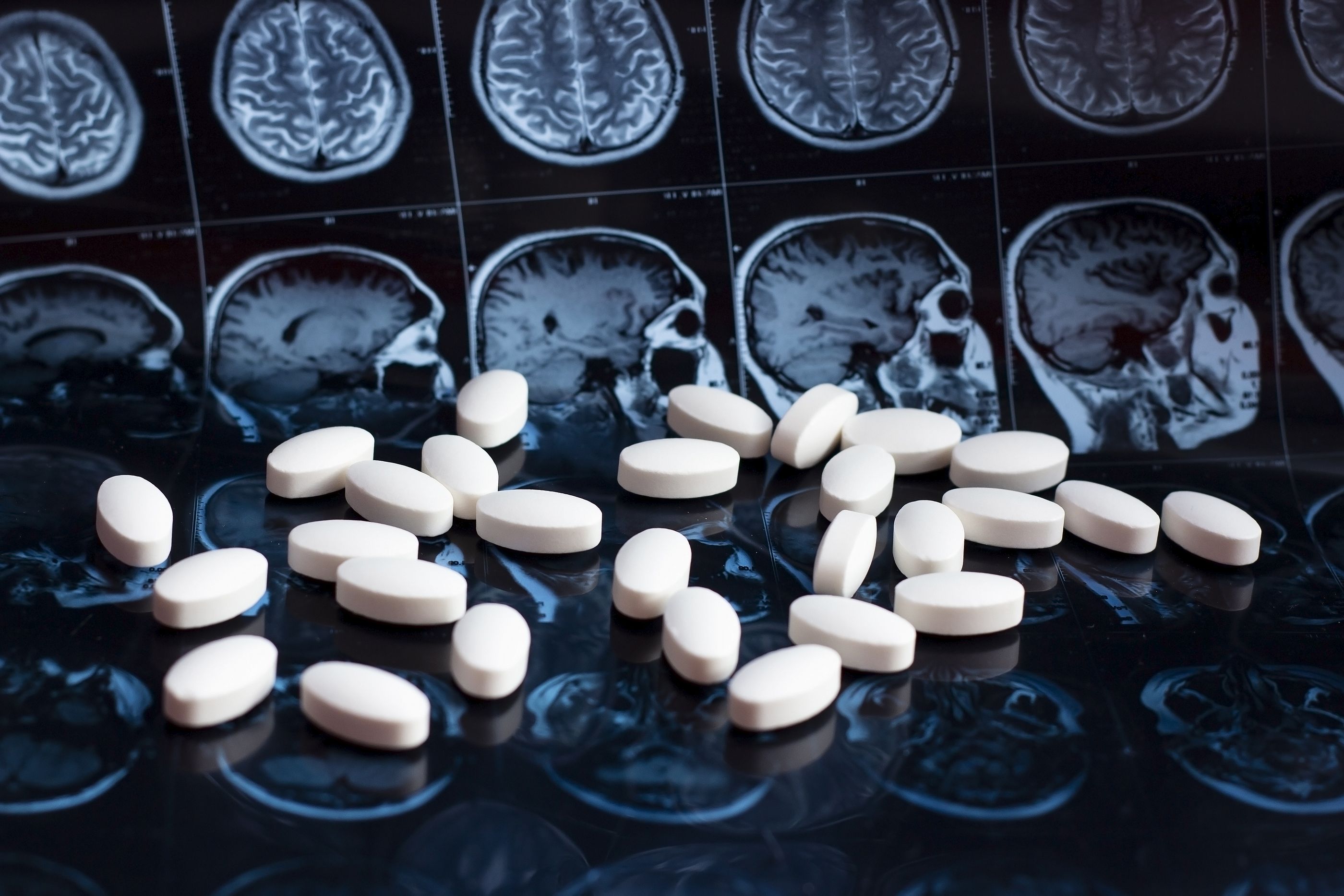 Dos medicamentos ya aprobados demuestran frenar los síntomas del alzhéimer
