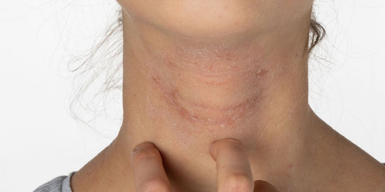 Cómo evitar la dermatits atópica por sudor