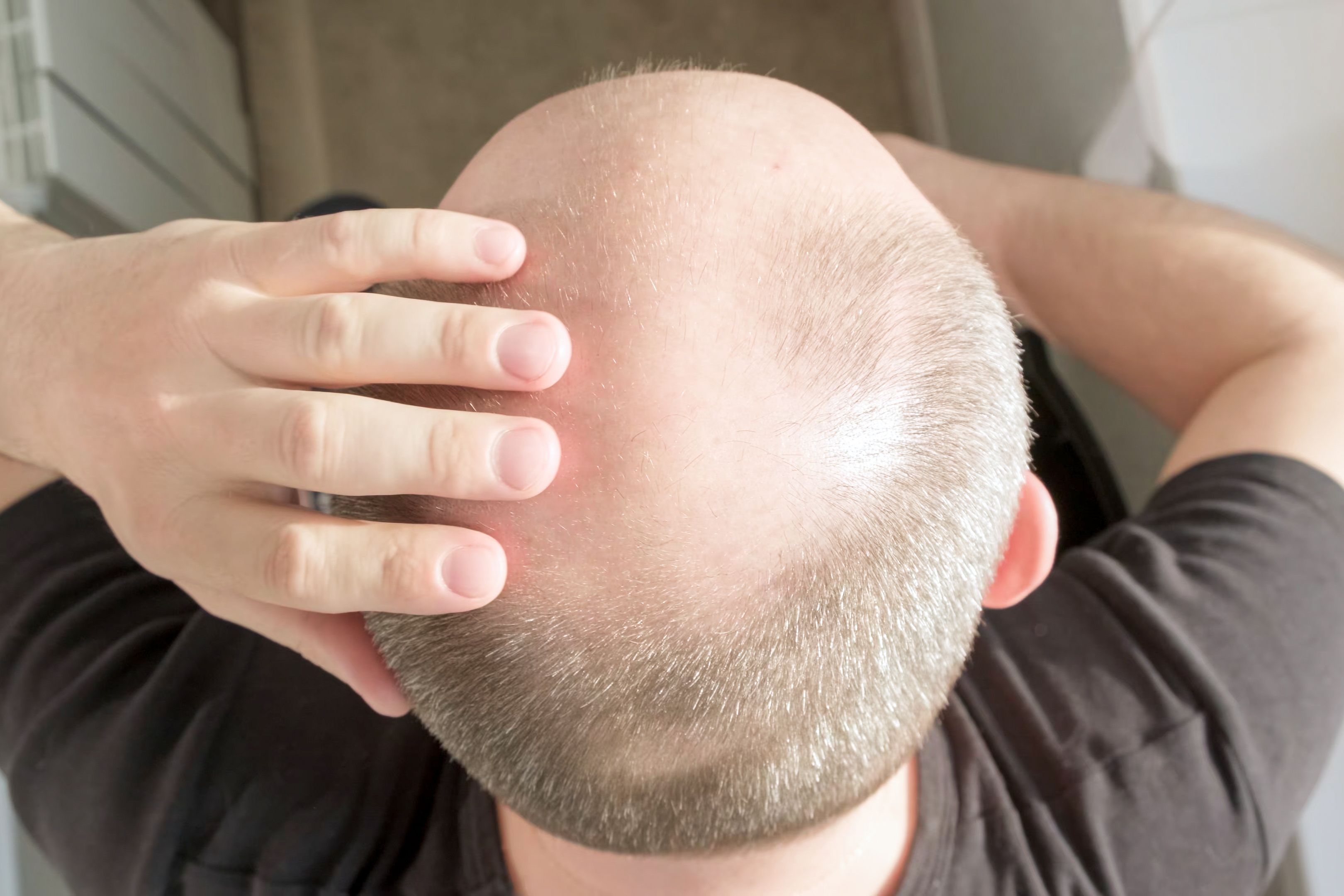 Descubren la la pérdida de pelo