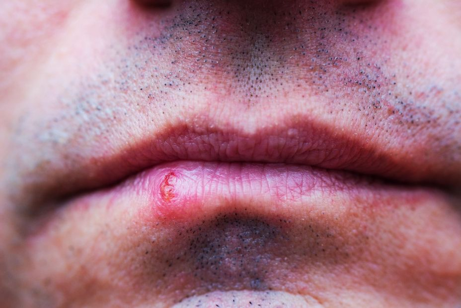 Estudian el herpes labial: así fue como se comenzó a expandir en humanos