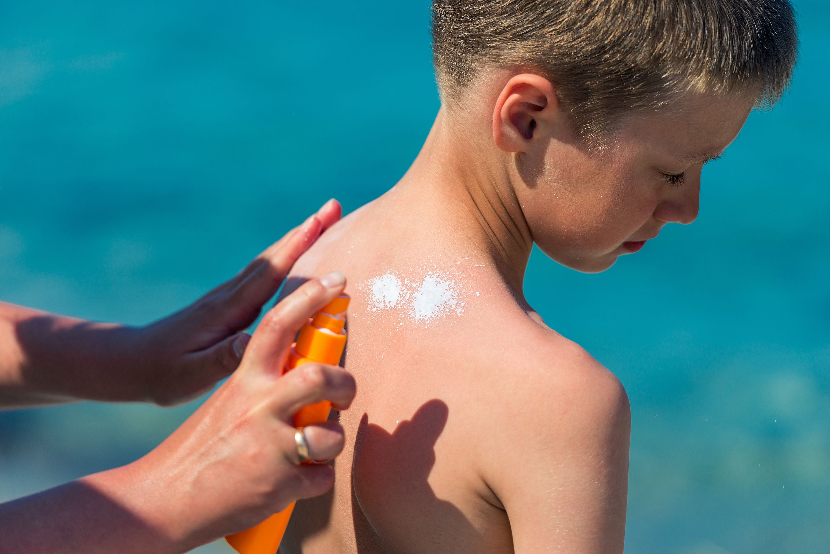 Las quemaduras en niños multiplican el riesgo de cáncer de piel de adultos