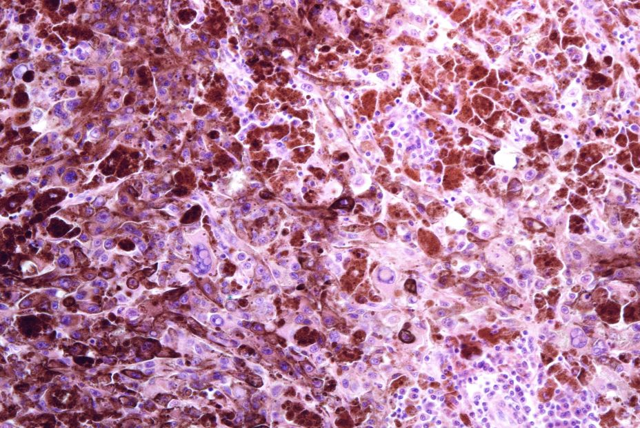 Un estudio revela nuevos avances sobre el melanoma