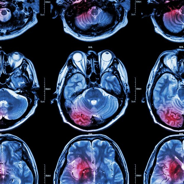 Encuentran un fármaco para el tumor cerebral más frecuente y agresivo