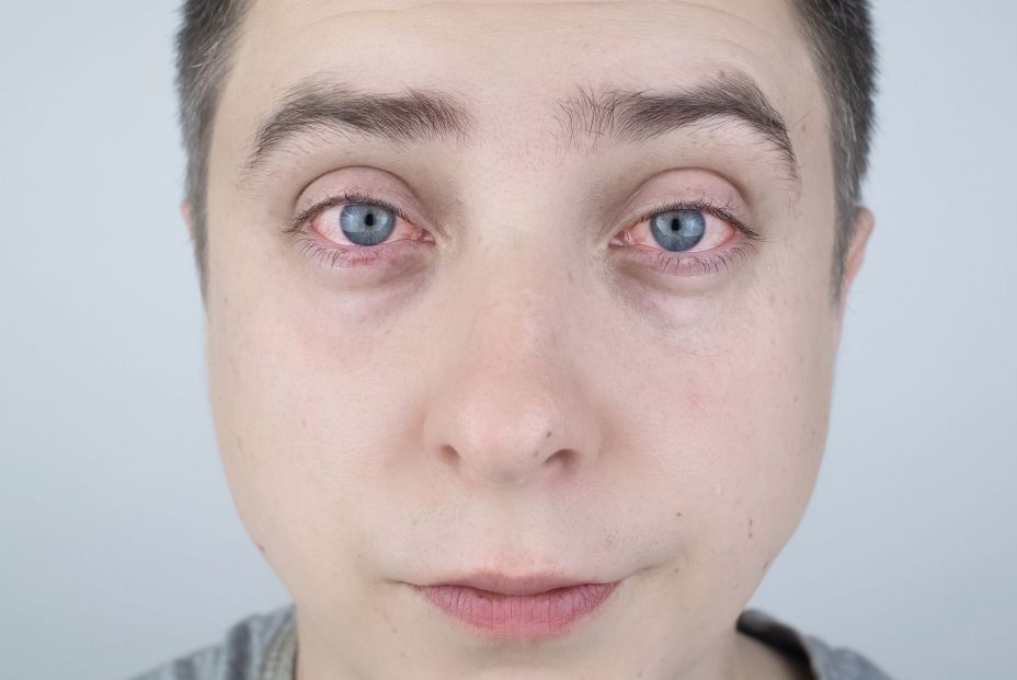 ¿Ojos rojos tras la piscina? Estos son los consejos que debes aplicar