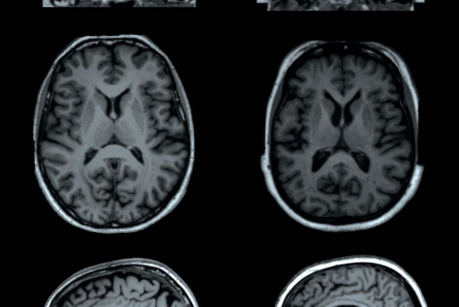 Un estudio revela que el covid puede realizar cambios estructurales en el cerebr