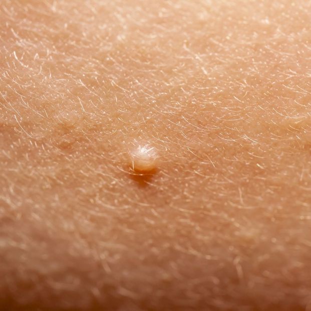 Qué son los moluscos contagiosos Qué son los moluscos contagiosos