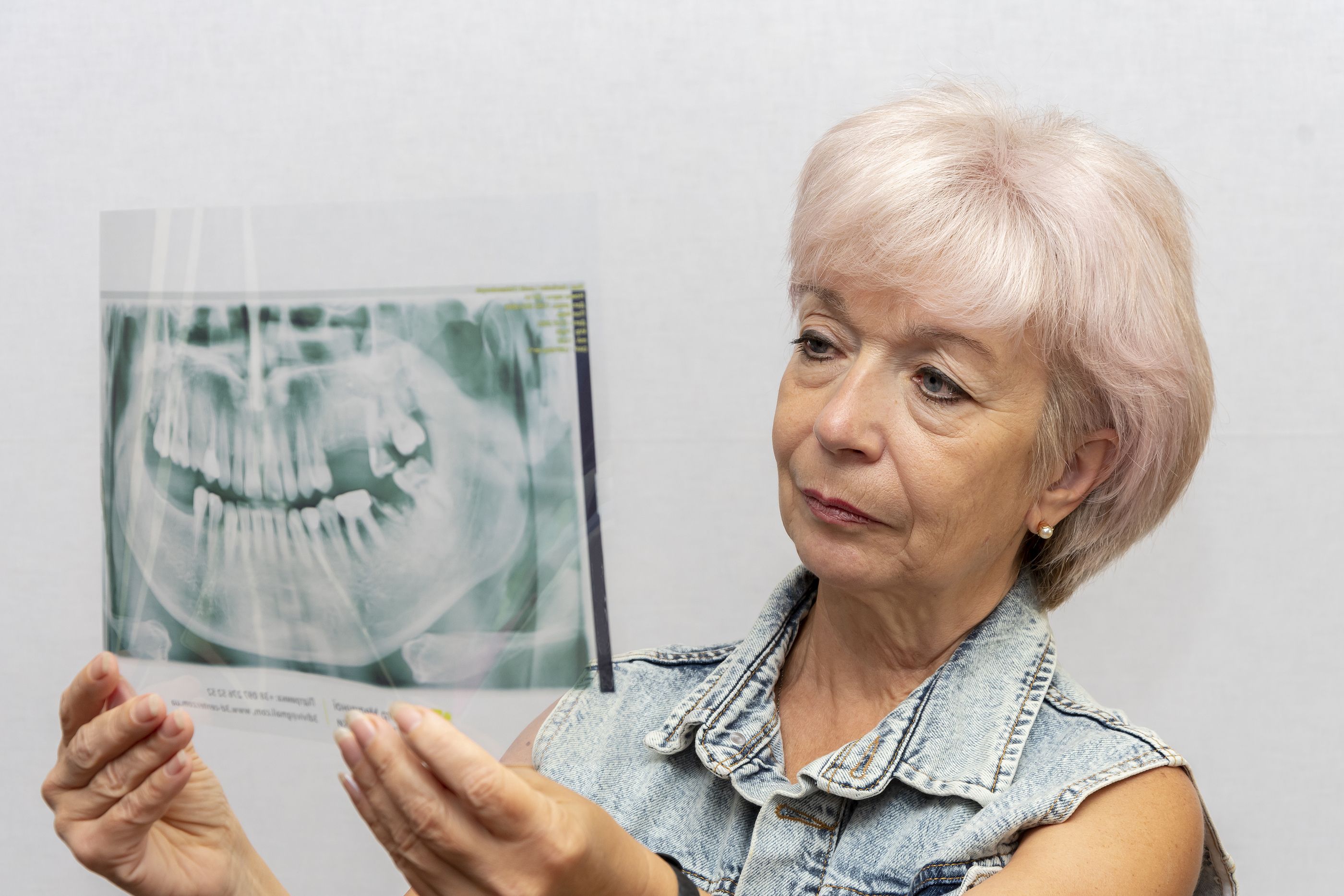 Relacionan una mala salud dental con la aparición de demencia o deterioro cognitivo