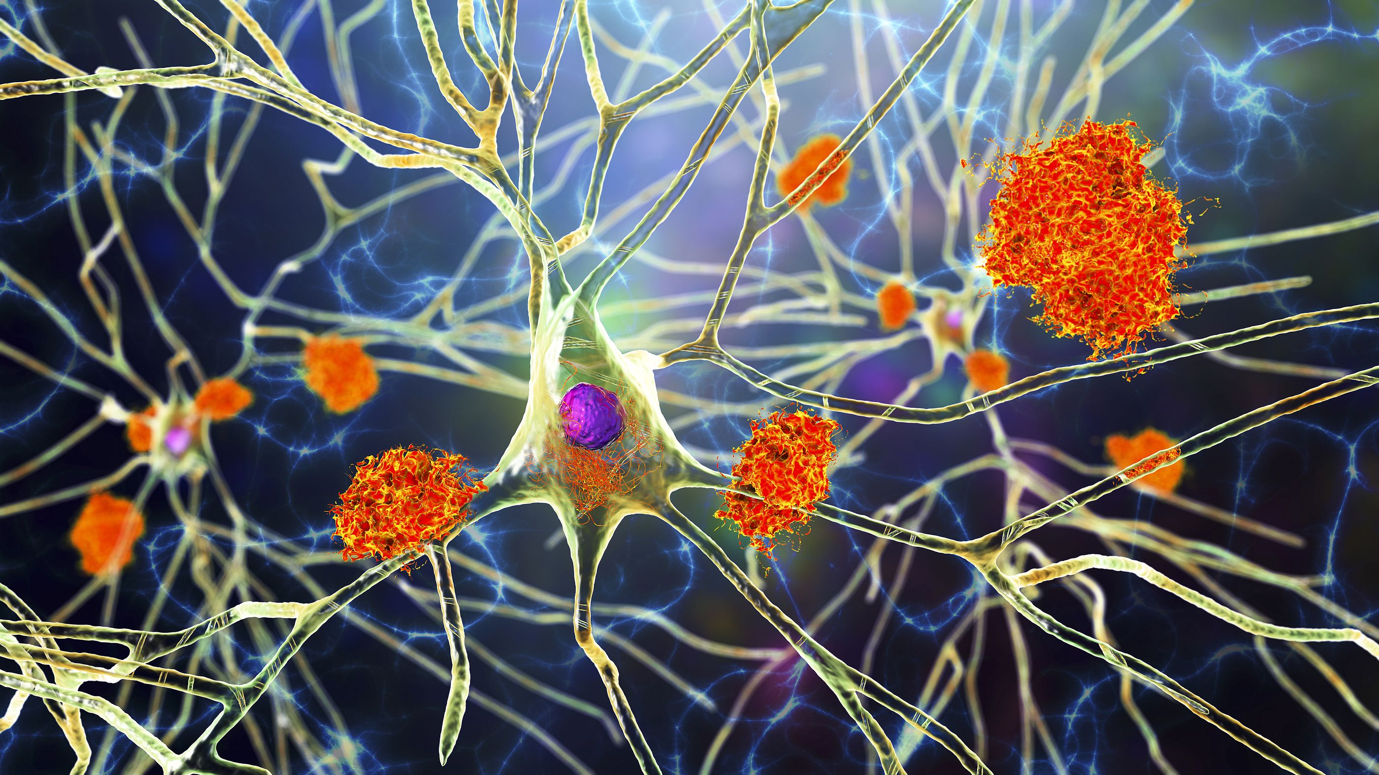 Un nuevo estudio refuta la teoría predominante sobre el alzhéimer