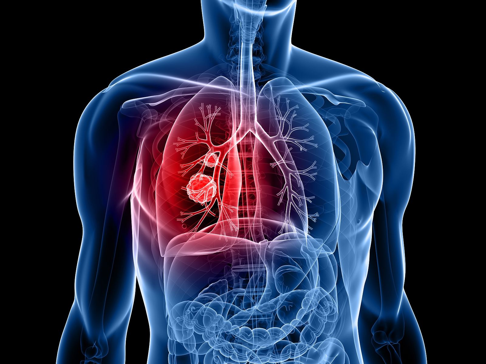 El perfil del paciente con cáncer de pulmón es un hombre fumador de 60 años