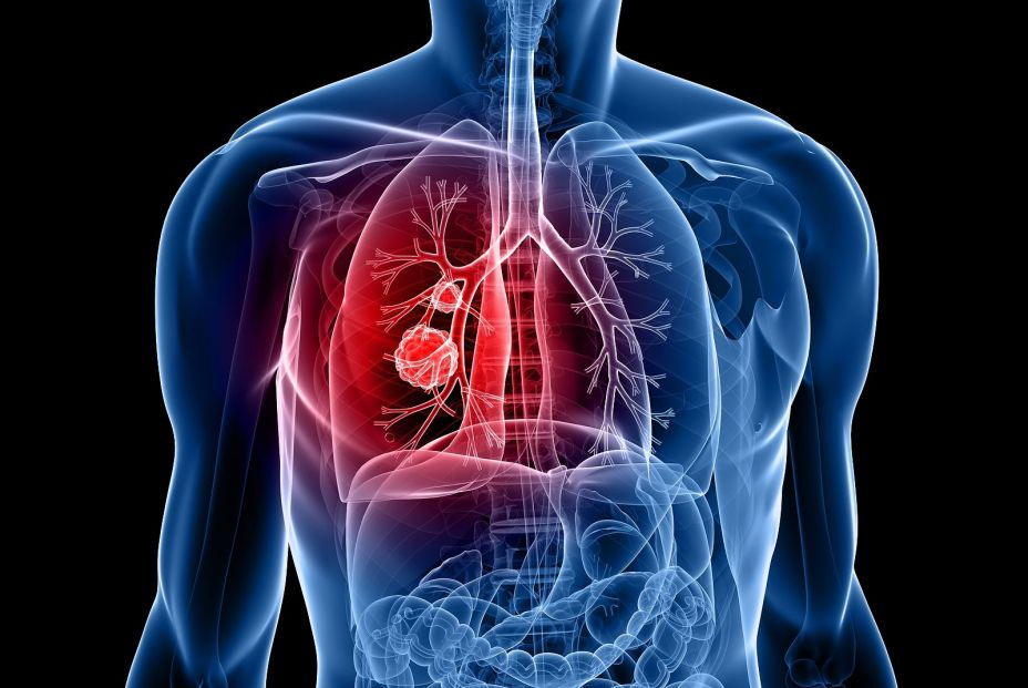 El perfil del paciente con cáncer de pulmón es un hombre fumador de 60 años