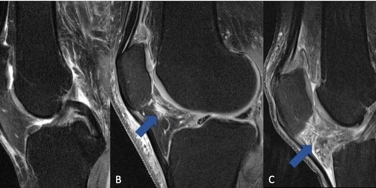 EuropaPress 4824685 rodilla normal inflamacion zona senal mas alta lineas brillantes zona