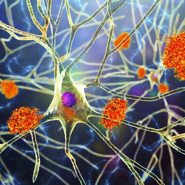bigstock Neurons In Alzheimer s Disease 410496982