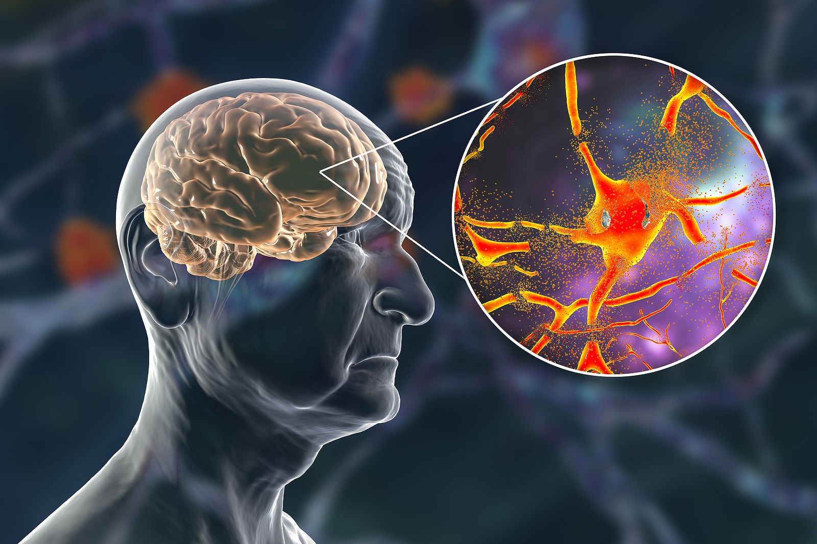 El aumento de la proteína beta amiloide en el cerebro podría ser un cambio que ocurre con la edad