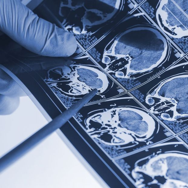 Buena noticia para el riesgo de alzhéimer: los cerebros humanos son cada vez más grandes