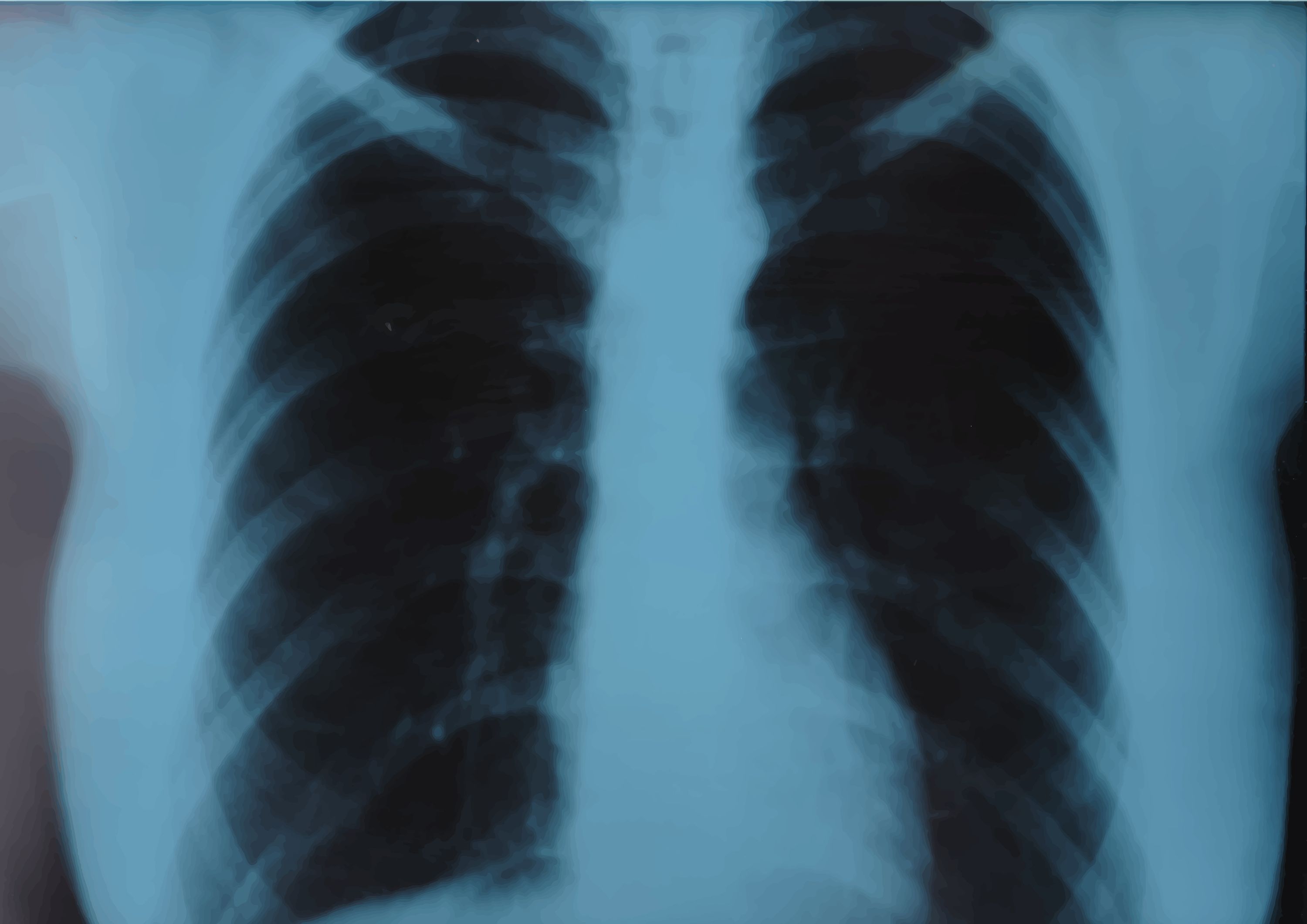 La inteligencia artificial predice el riesgo de enfermedad cardiaca usando una sola radiografía