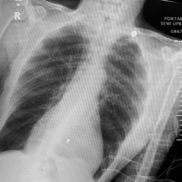 bigstock Chest X rays  Three In A Row  454191279