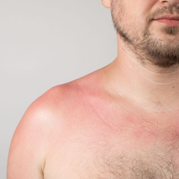 bigstock Skin Of A Person With Sunburn  463460195