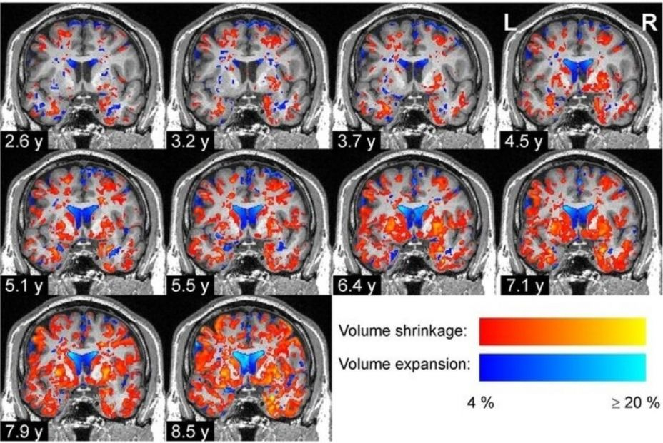 Degeneracion progresiva tejido cerebral paciente enfermedad parkinson
