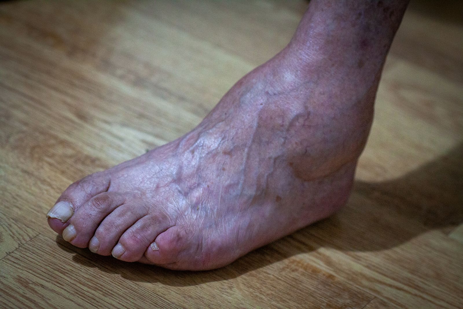 Aumentan los casos de lepra: ¿está volviendo esta enfermedad olvidada?