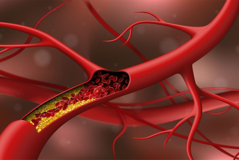 bigstock Artery Blocked By Cholesterol  389980579