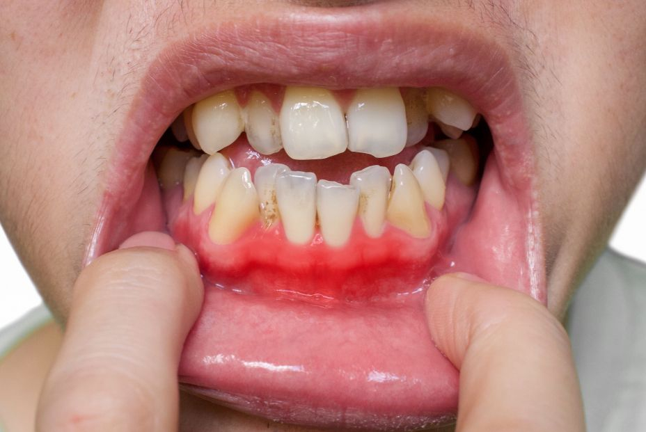 bigstock Inflammation Of Gum Called Gin 466324249