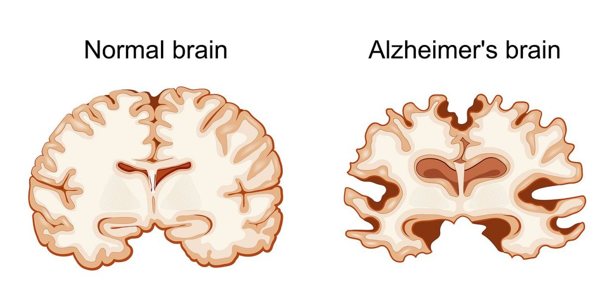 bigstock Normal Brain And Alzheimer s B 460845359