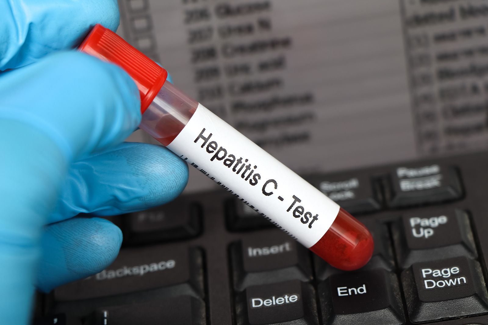 Descubren una prueba más sencilla, rápida y barata para detectar la hepatitis C