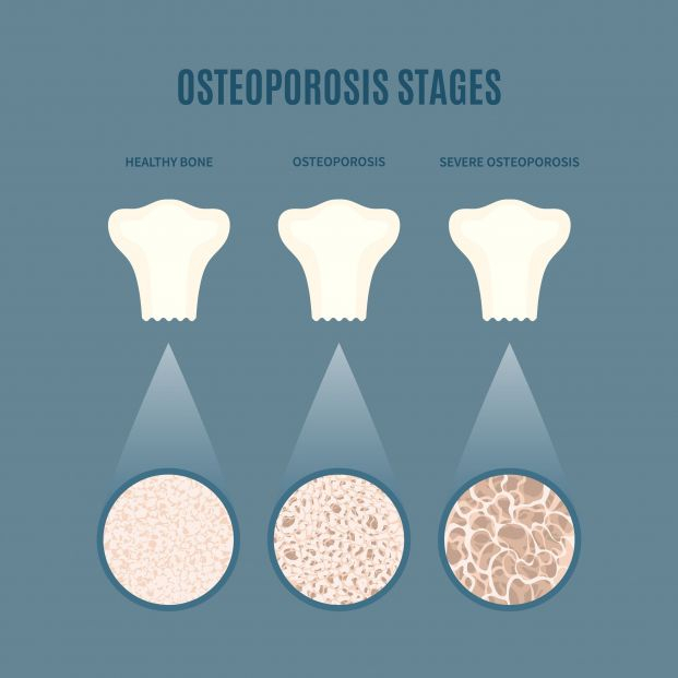 bigstock Osteoporosis Bone Density Loss 469845515