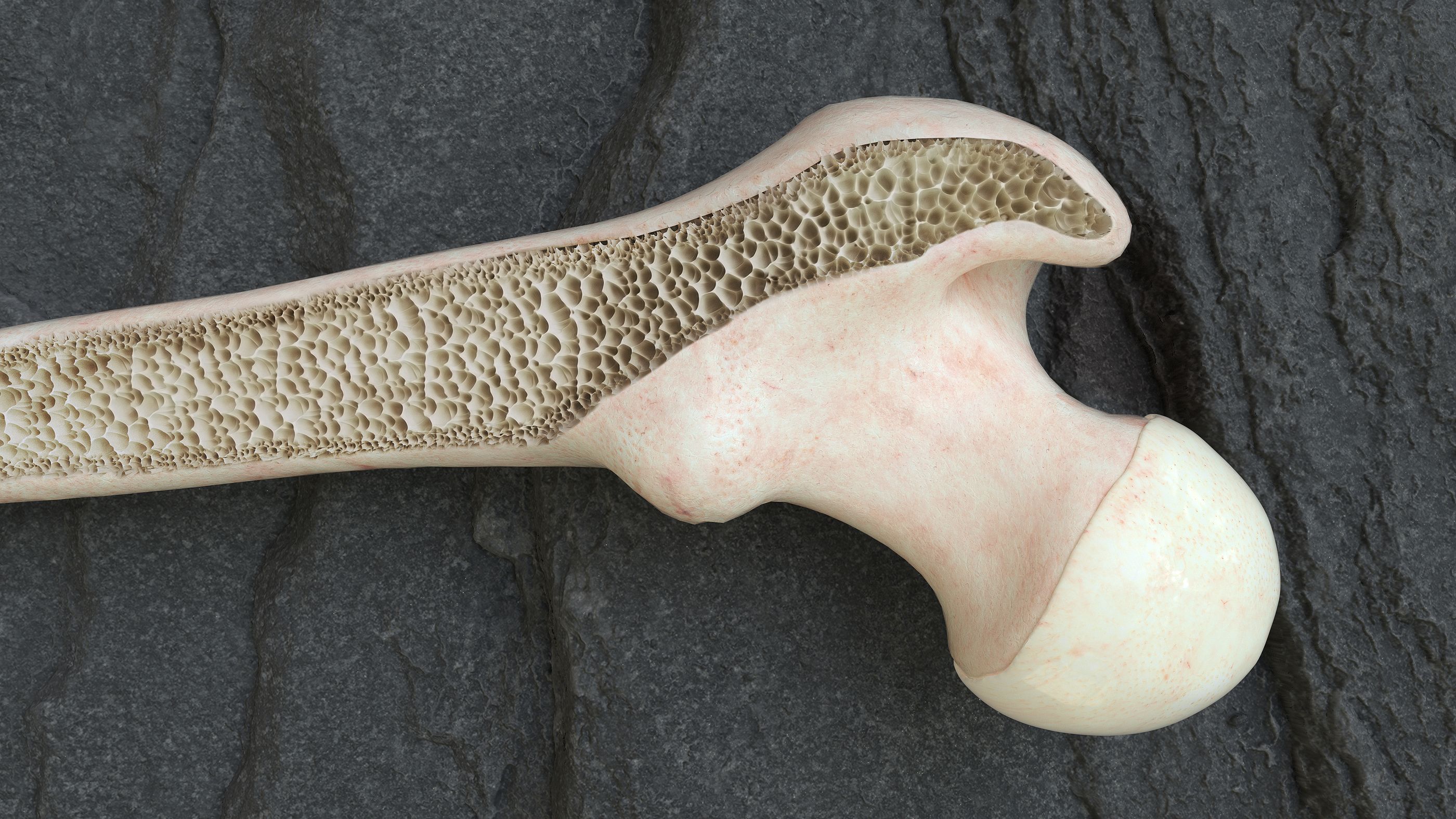 Crean modelos virtuales de huesos con osteoporosis para ayudar a predecir el riesgo de fractura