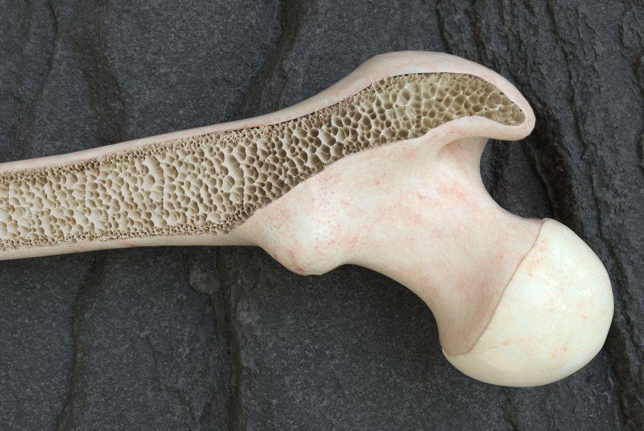 Osteoporosis Osteoporosis