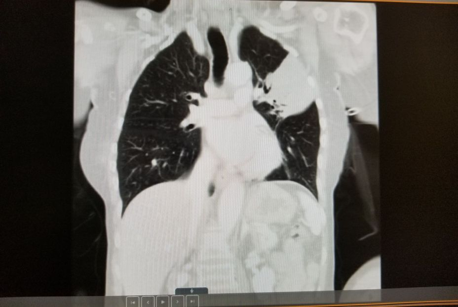 Pulmones infectados por neumonía por el Cryptococcus neoformans