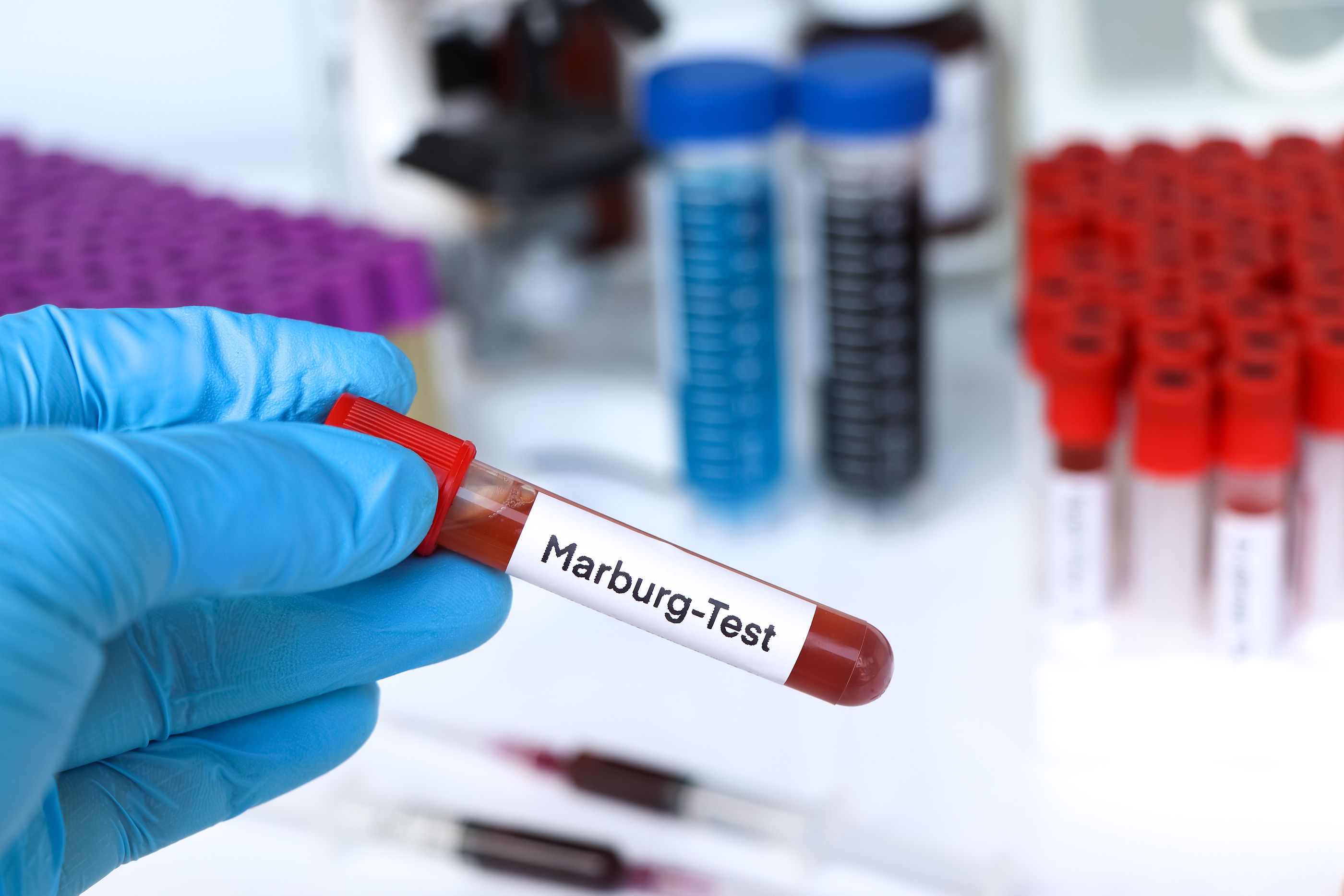 Virus de Marburgo: ¿Qué es? ¿Llegará a España? ¿Cuáles son sus síntomas?