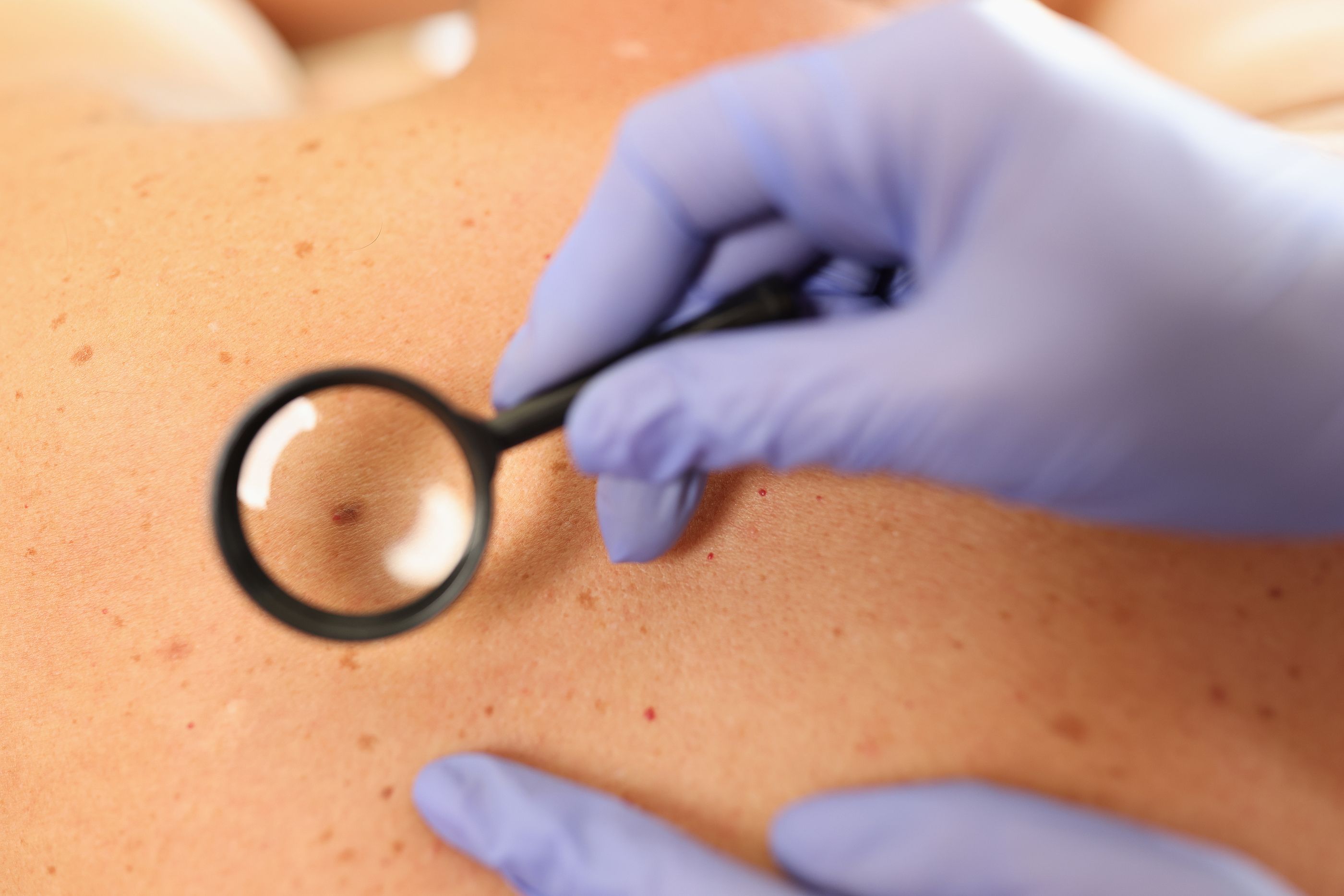 Golpe al cáncer de piel: identifican un marcador que avisa de cuáles podrían provocar metástasis