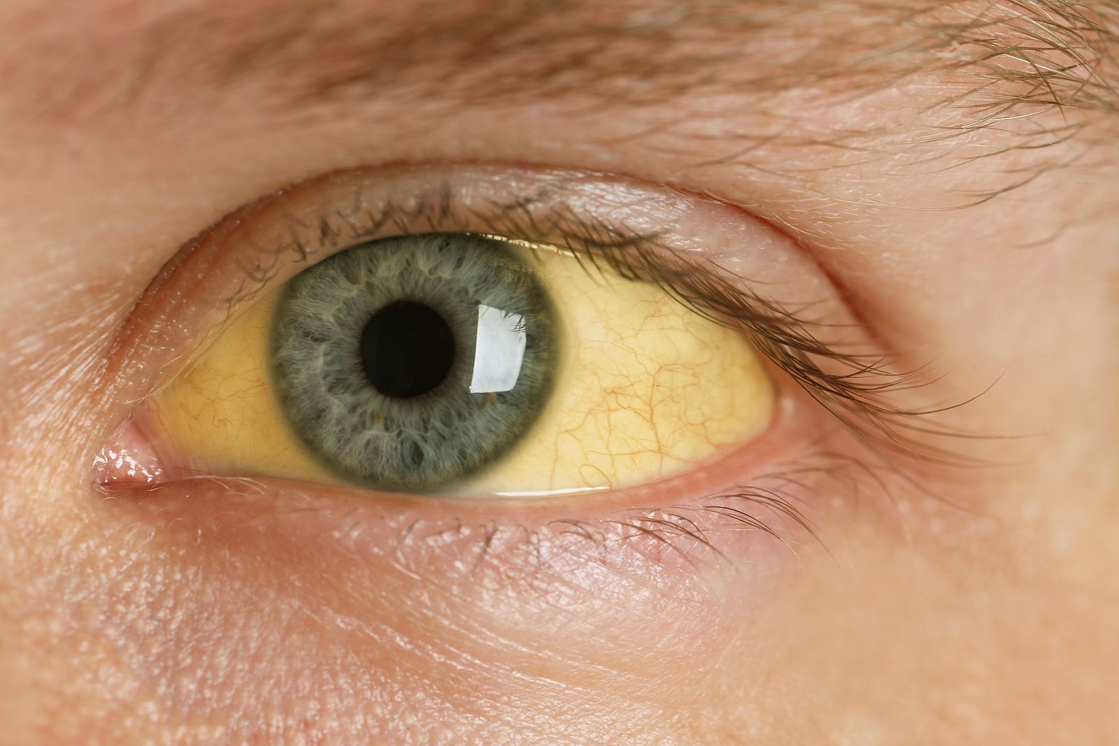 Ojos amarillos: qué enfermedades pueden estar detrás