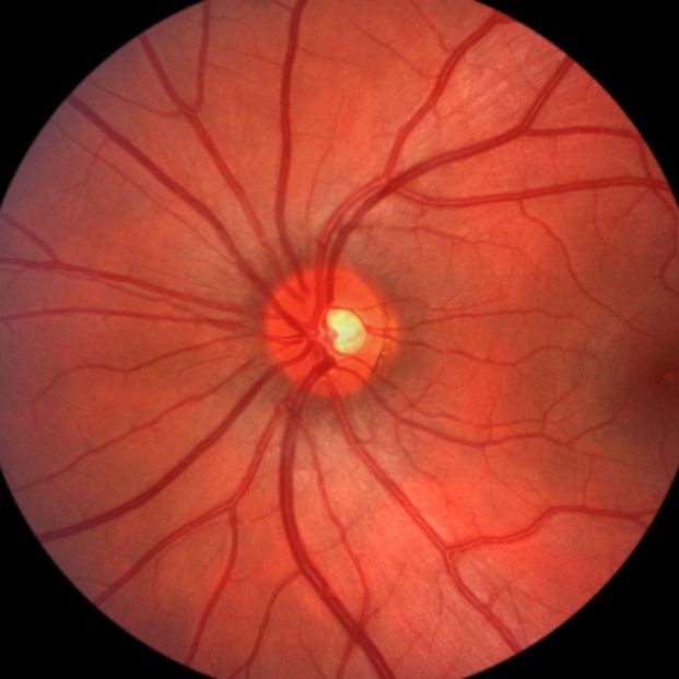 retinopatía diabética retinopatía diabética