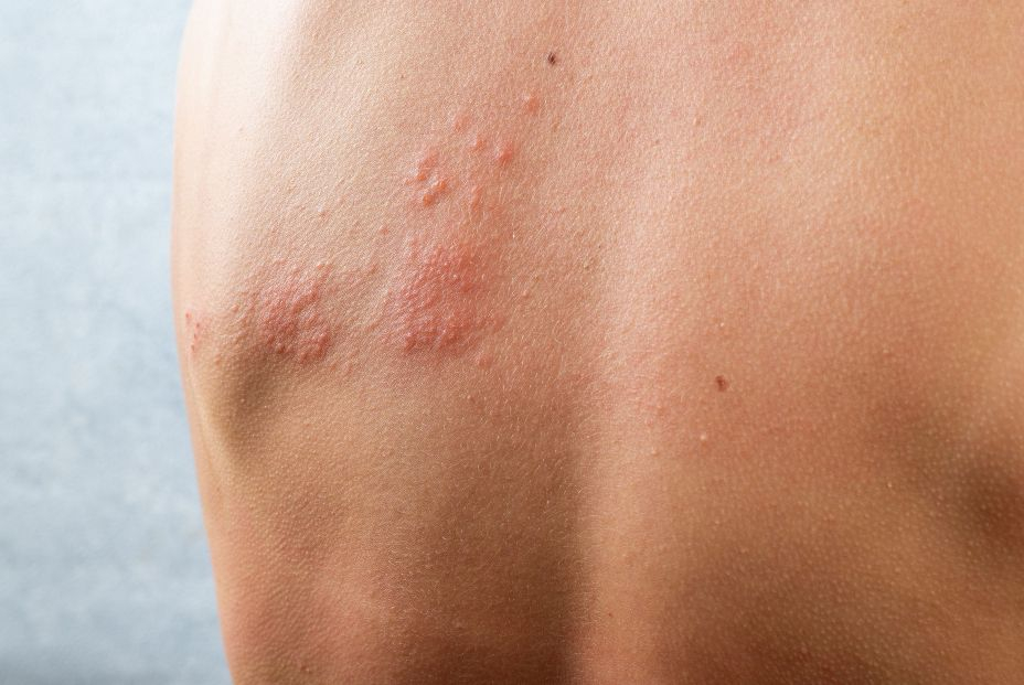 Descubren un nuevo antiviral contra el herpes simple resistente a los tratamientos