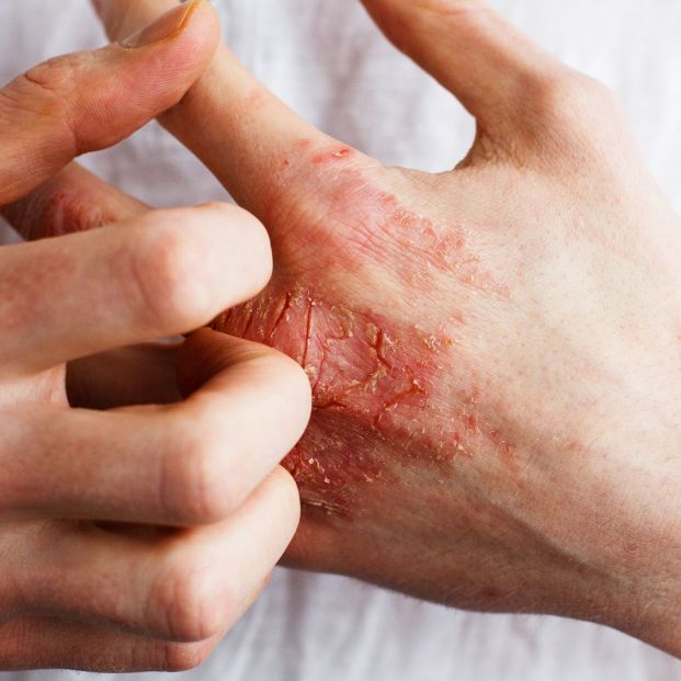 psoriasis y enfermedad intestinal