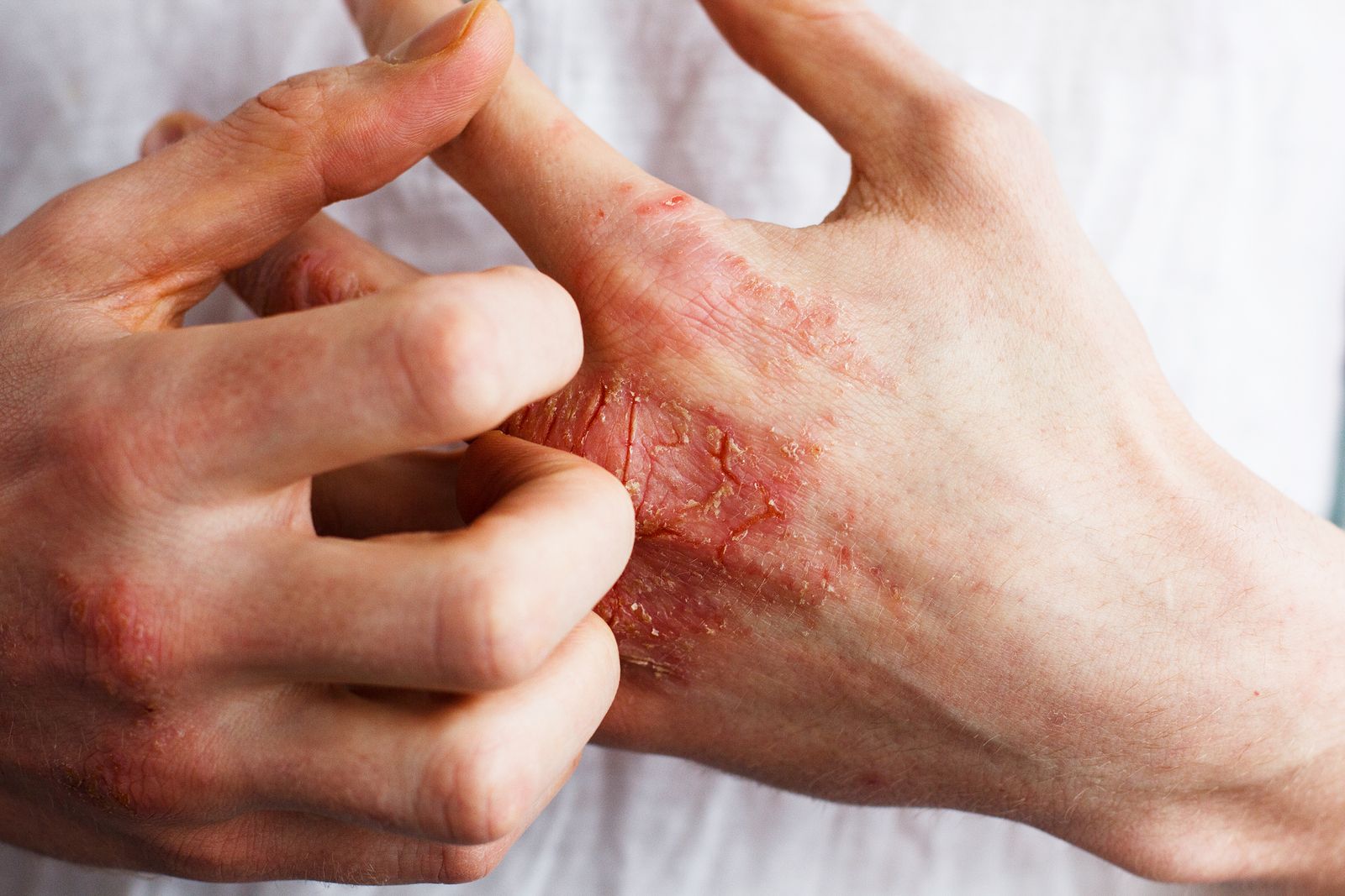 Eccema o psoriasis: ¿en qué se diferencian?