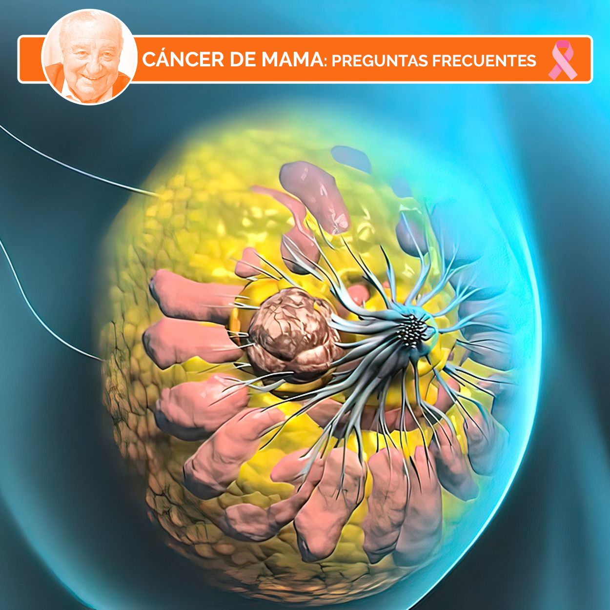 ¿Cuáles son los estadios del cáncer de mama? ¿Qué significa que haya metástasis?