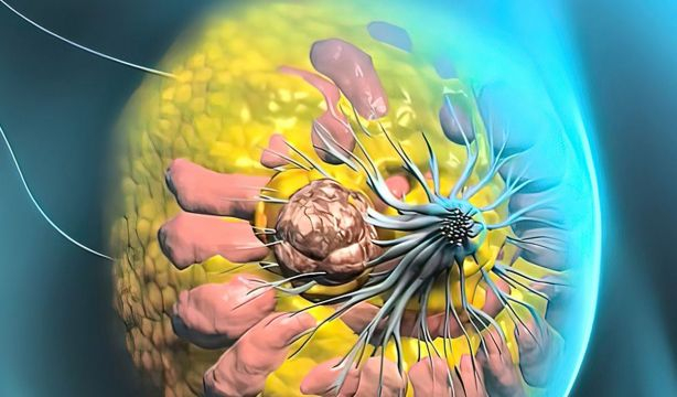 ¿Cuáles son los estadios del cáncer de mama? ¿Qué significa que haya metástasis?