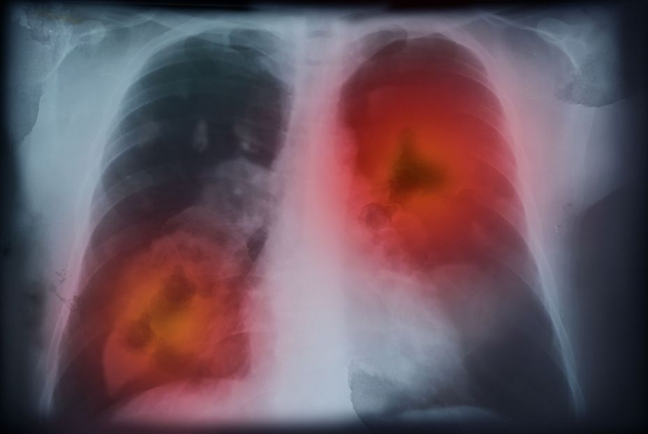 Un biomarcador permite saber si un tratamiento de cáncer de pulmón funciona